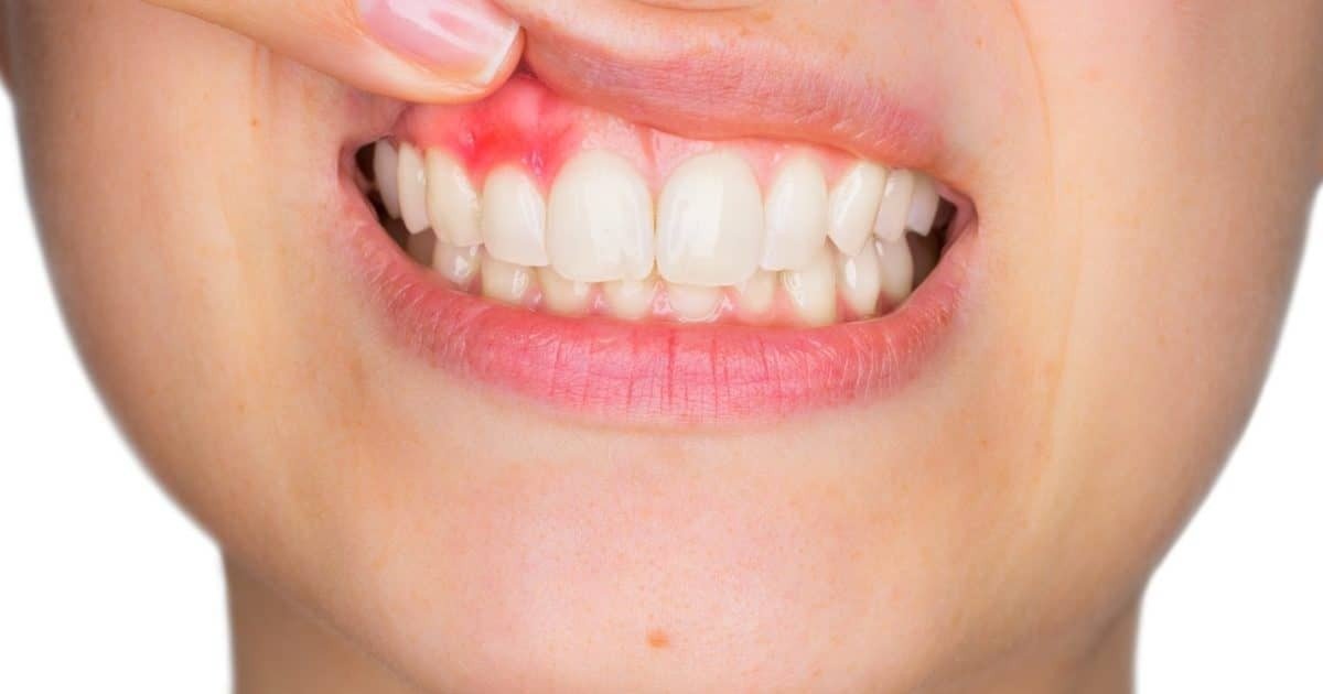 Abscess Drainage (Per Dressing)