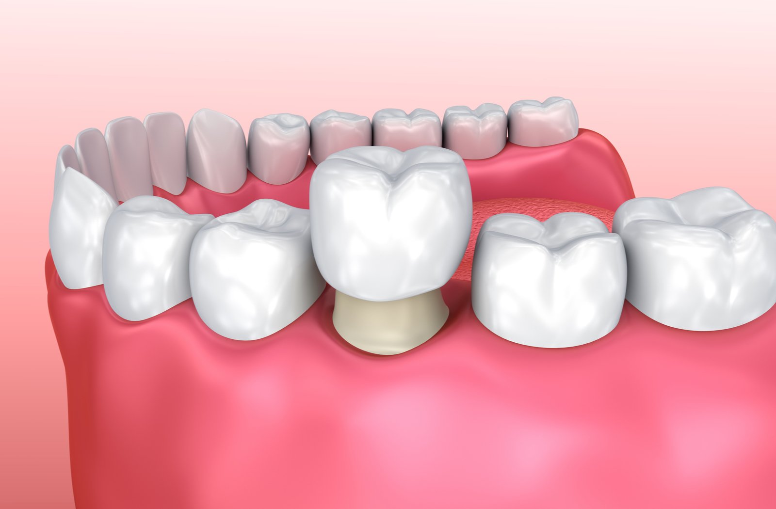 Crown Regular (Per Tooth)