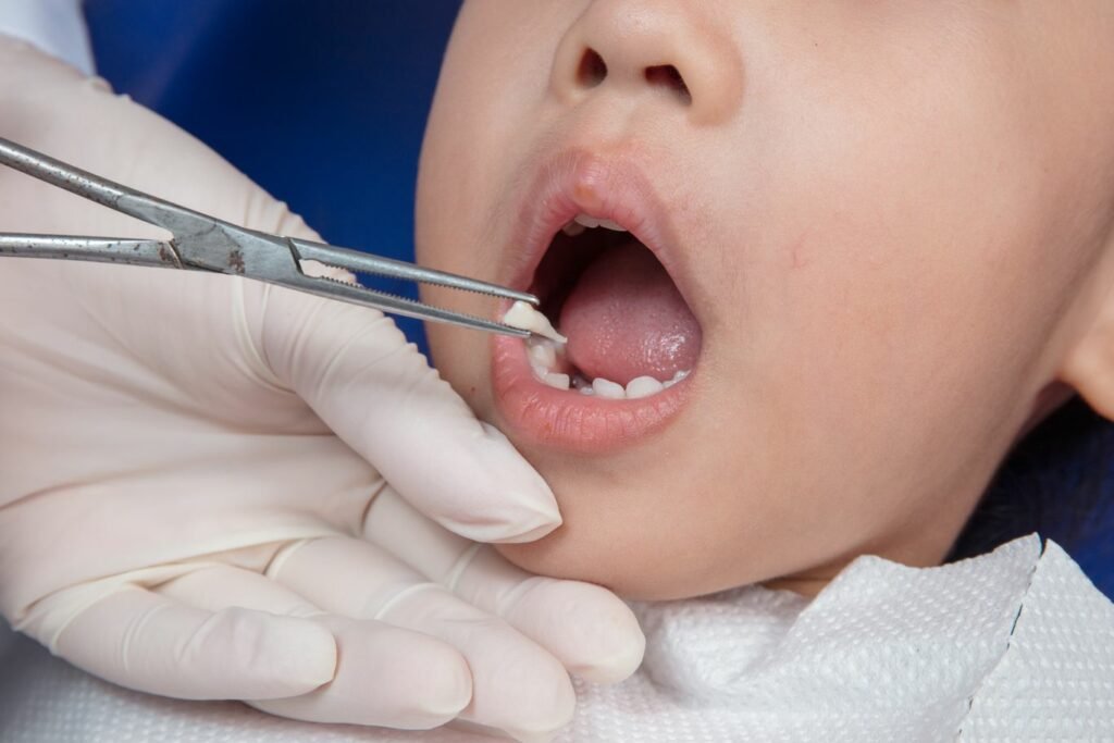 Extraction (Children)