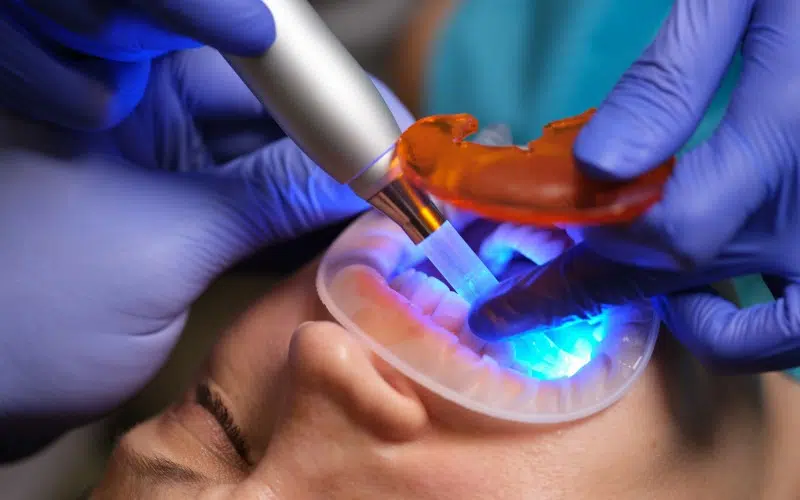 Filling (Light cure composite)