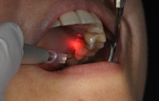 Laser Treatment