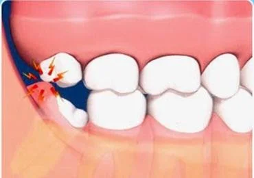Operculectomy
