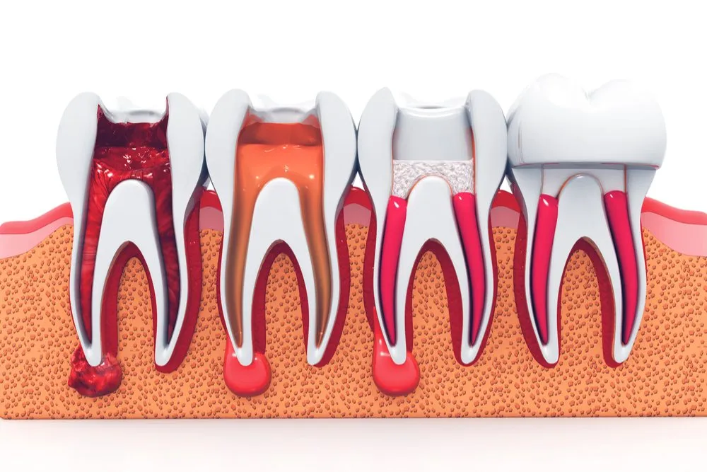 Re Root Canal Treatment