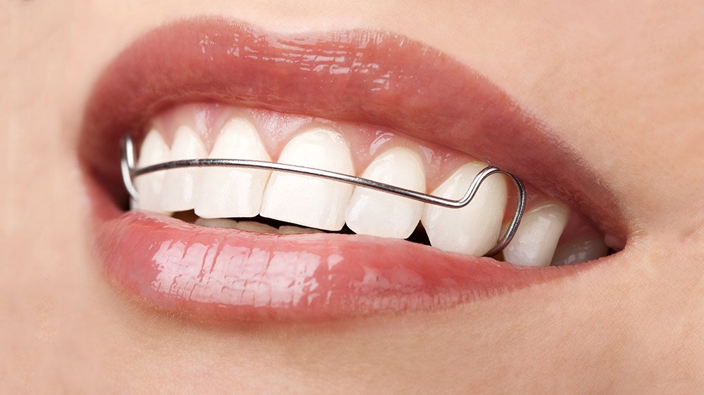 Removable Orthodontic Treatment (per Appliance)