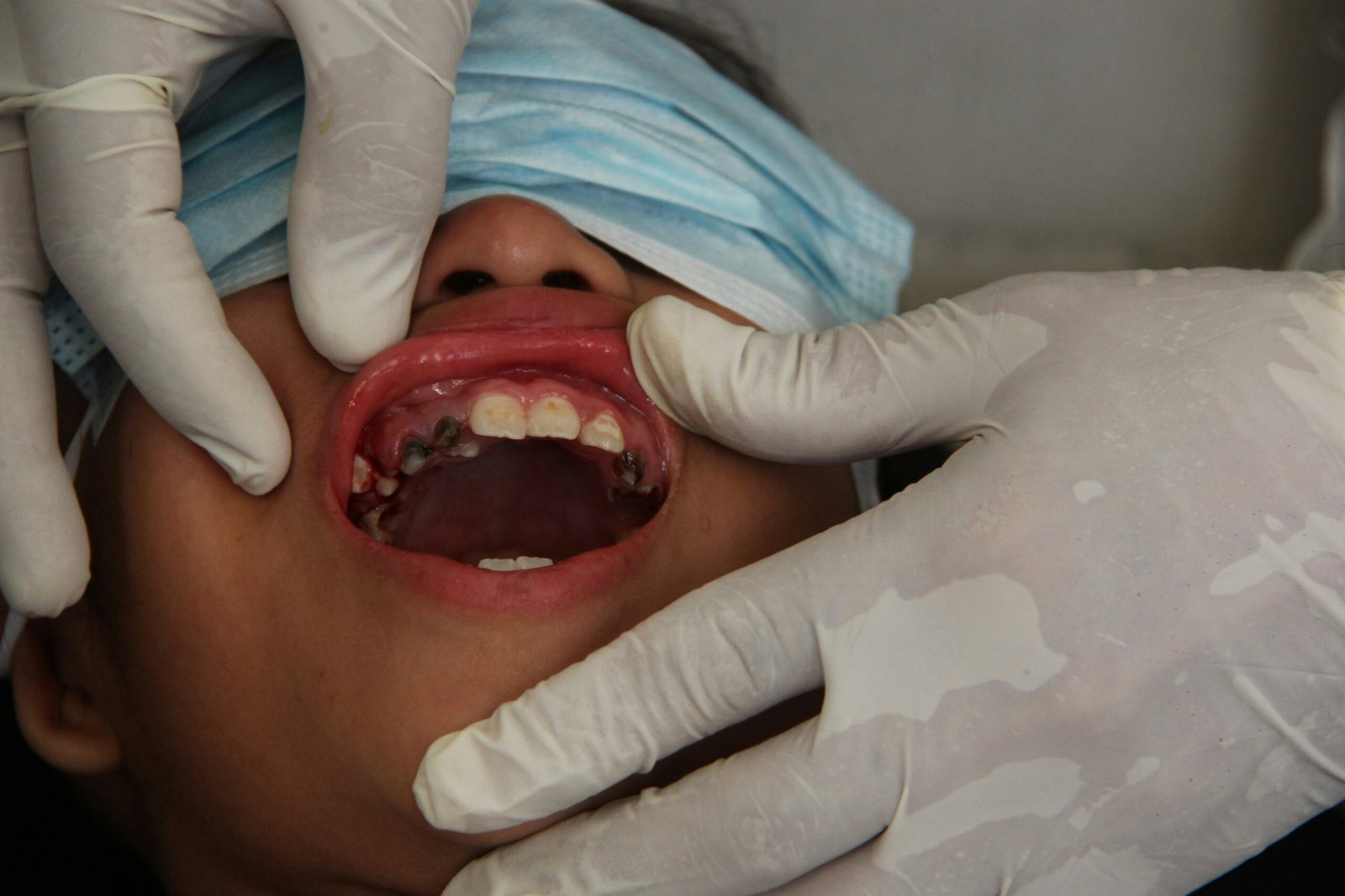 Pulpotomy