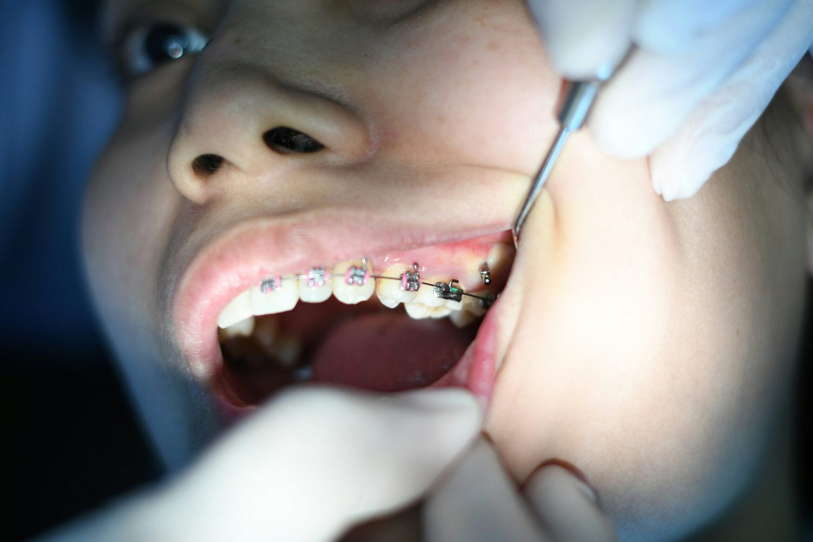 Fixed Orthodontic Treatment