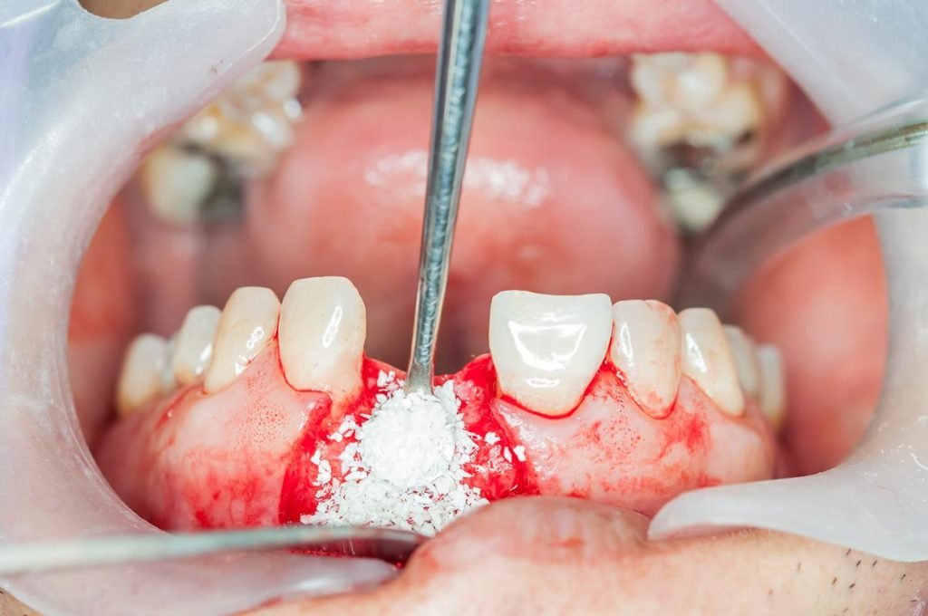 Bone Grafting/Advanced Periodontal Surgery/Tooth