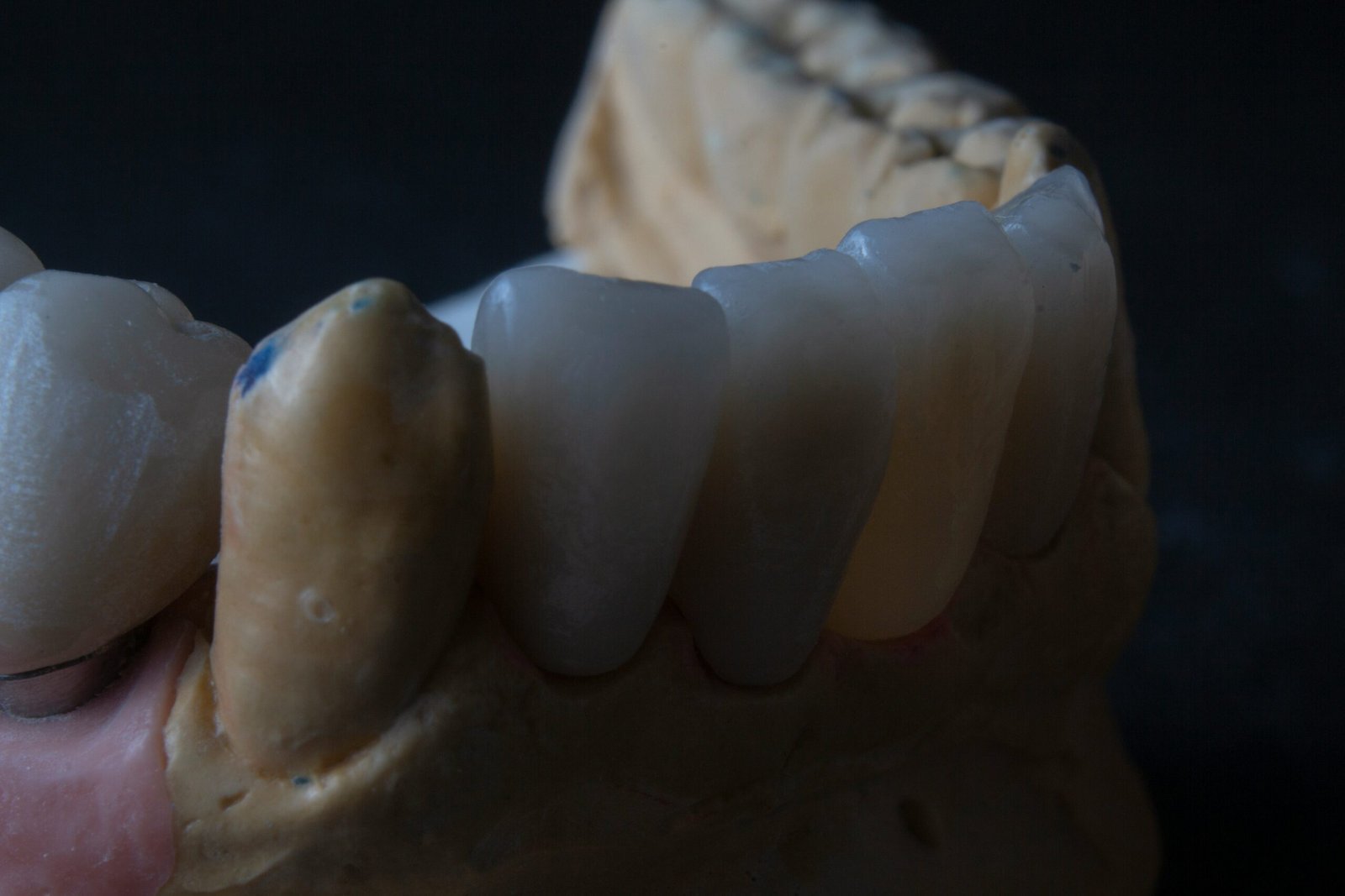 RCT With FVC (CAD/CAM, Single Layer)