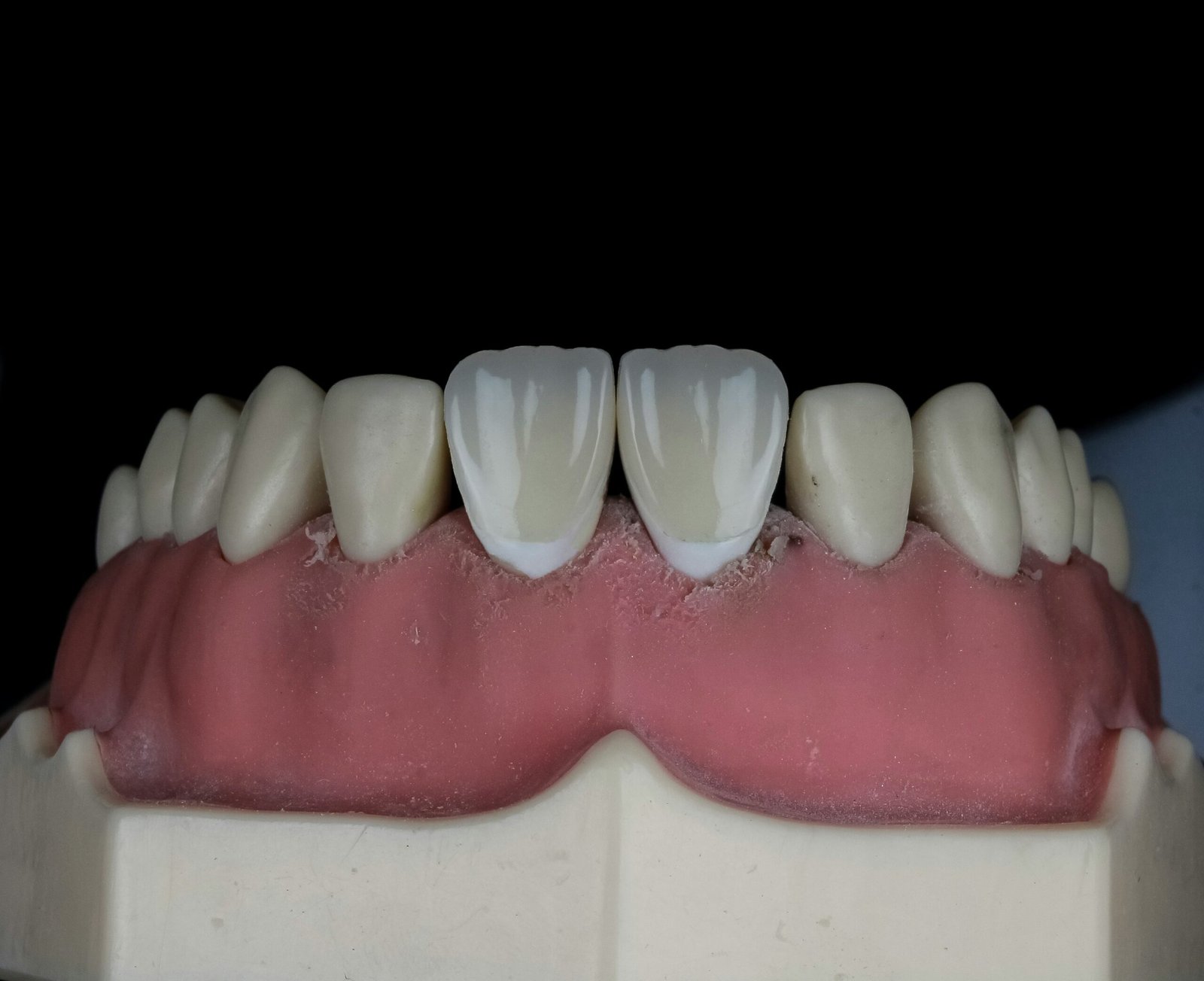 RCT With FVC (CAD/CAM, Multilayer)